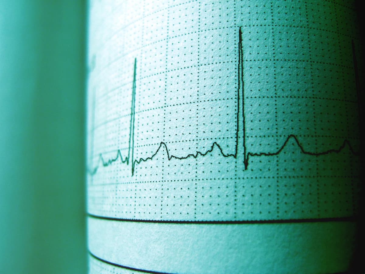 PVCs: Common, Usually Benign, Sometimes Not